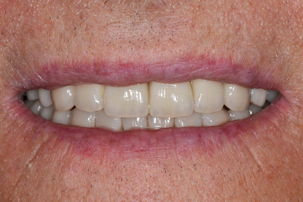 Patient mit komplett sanierten Zähnen im Ober- und Unterkiefer