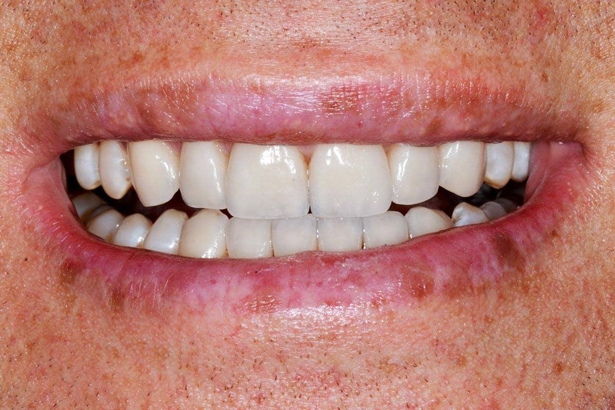 Patient mit Keramik-Veneers im Ober- und Unterkiefer