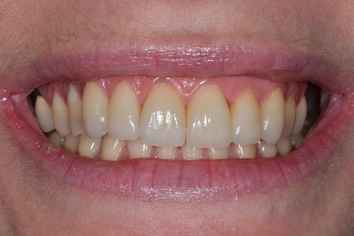 Patientin nach der Behandlung mit 8 Veneers