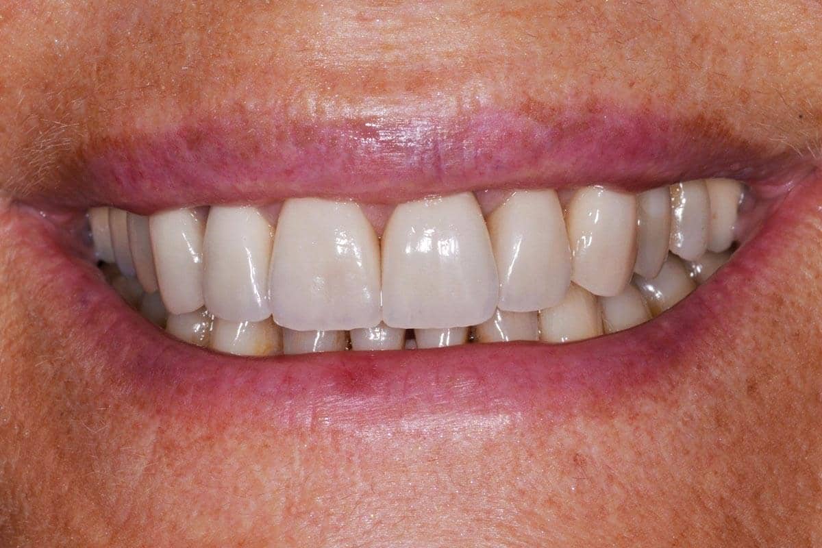 Patientin nach Einsetzen der 2 Kronen und 4 Veneers