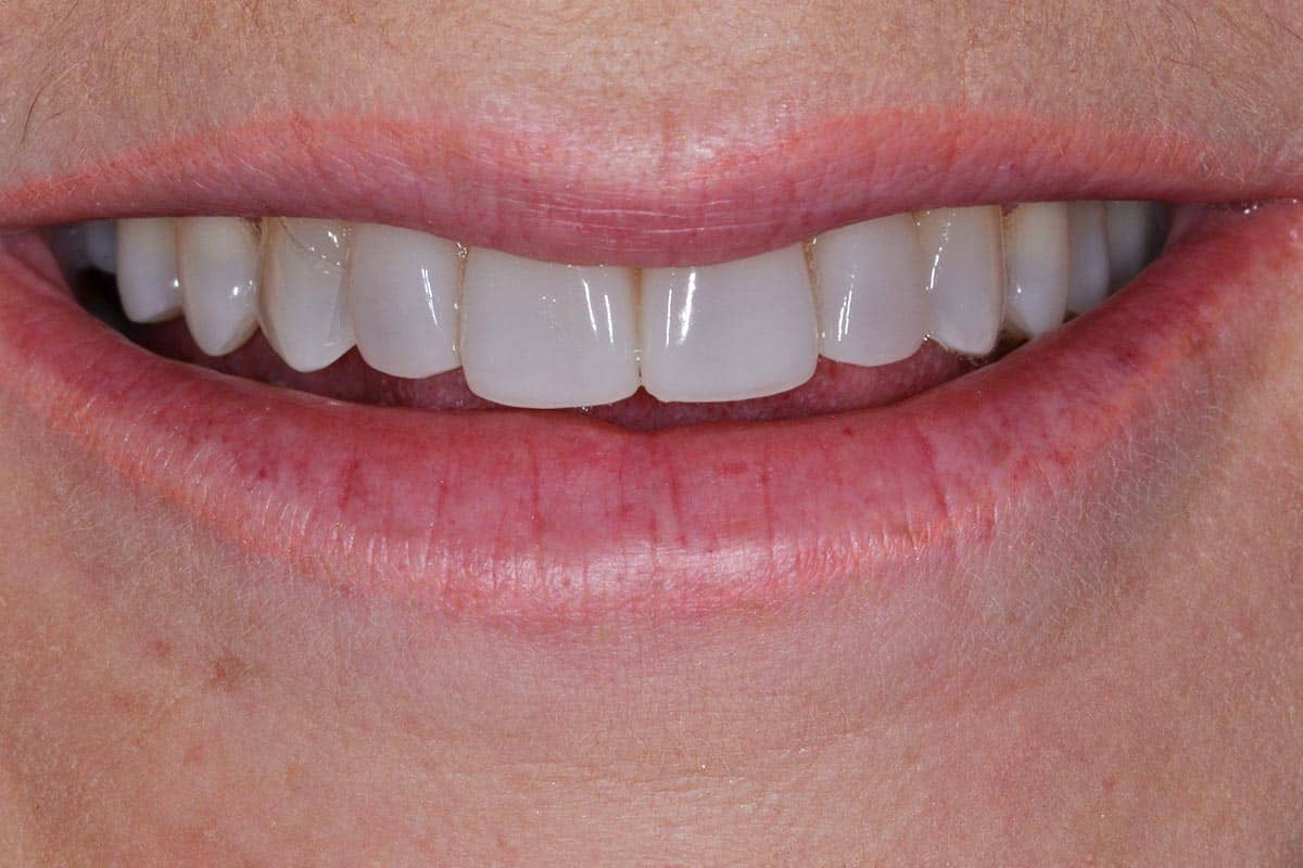 Patientin nach der Behandlung mit 4 Veneers auf den Frontzähnen