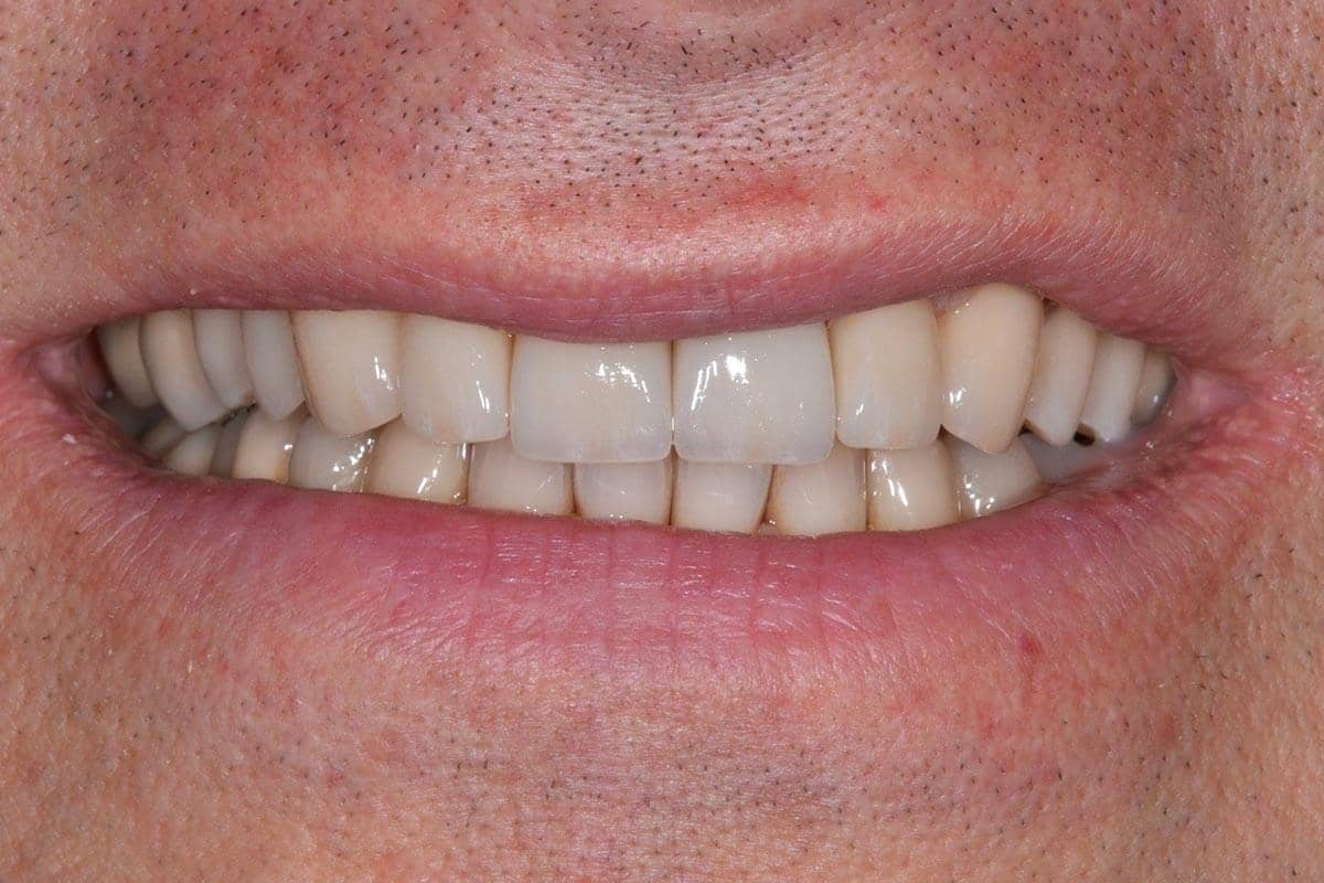 Patient nach dem Einsetzen von Veneers auf den Frontzähnen