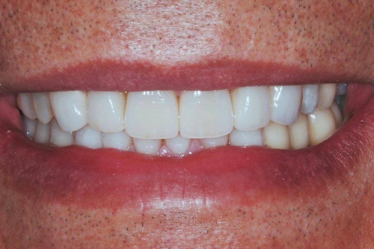 Patient nach Vollversorgung mit Kronen und Veneers