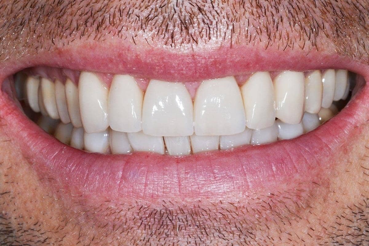 Patient nach der Behandlung mit Veneers im Oberkiefer und Invisalign für den Unterkiefer