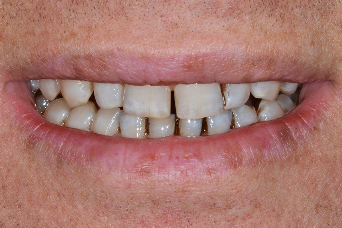 Patient vor dem Einsetzen der Keramik-Veneers