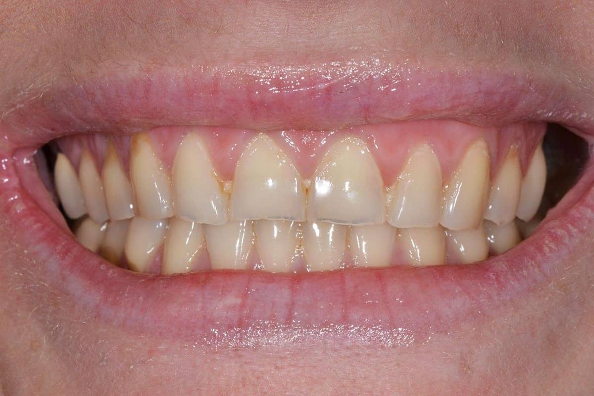 Patientin mit Schmelzerosionen an den Zähnen