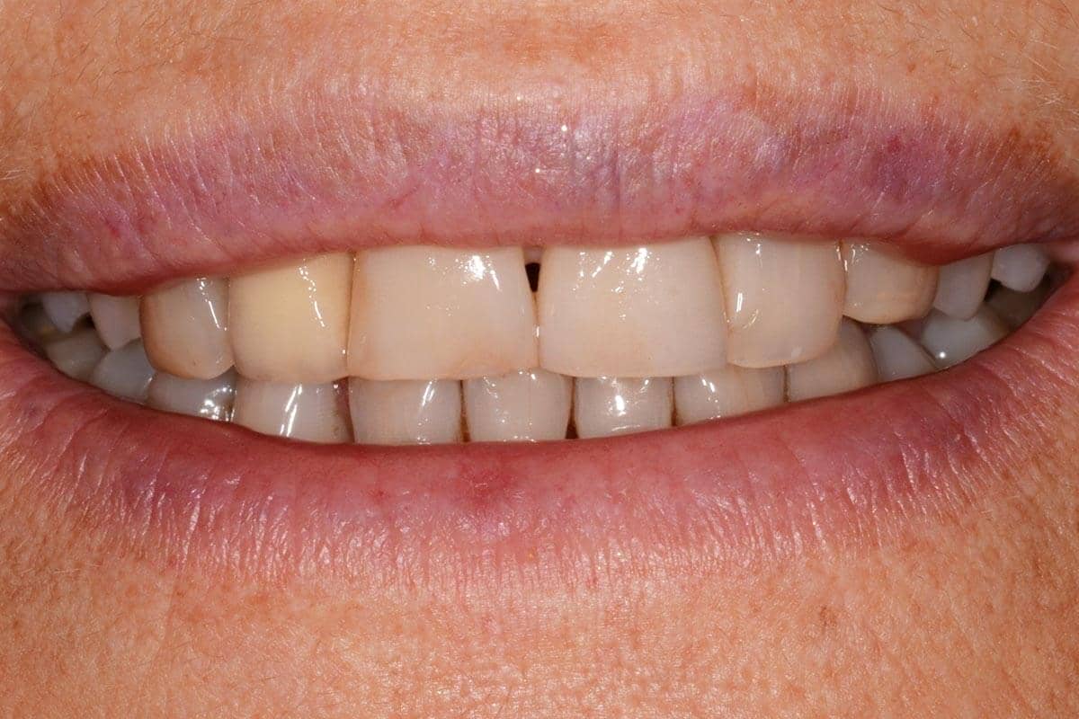 Patientin vor der Behandlung mit Veneers und Kronen