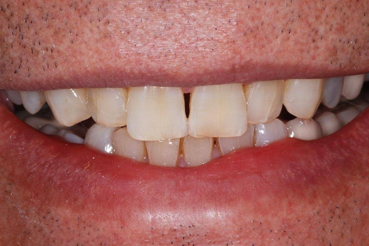 Patient vor der Vollversorgung in der Zahnarztpraxis