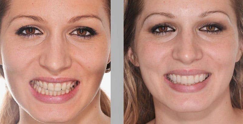 Vergleich vor und nach der ästhetischen Zahnkorrektur einer Patientin