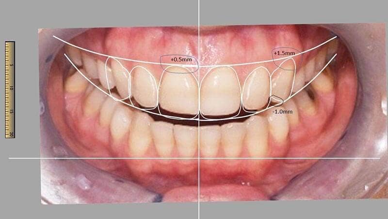 Computer-Simulation Gebiss mit Markierung der Zahnkorrekturen