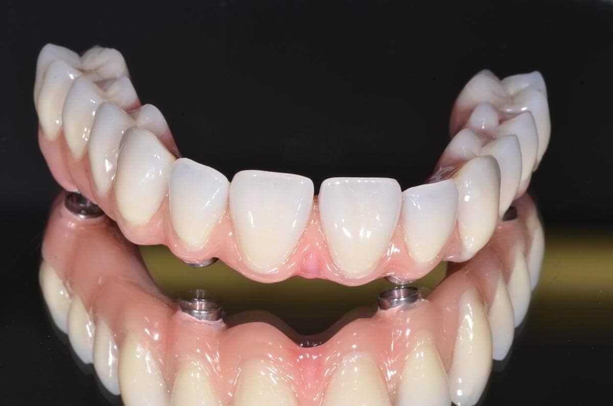 All-On-4 Implantat Oberkiefer