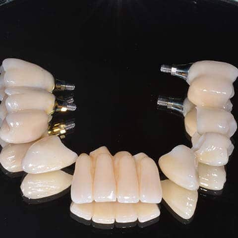 Einzelne Zahnimplantate für Schneide- und Kauzähne