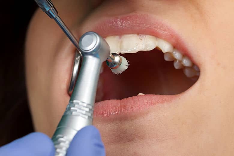 Professionelle Zahnreinigung in der Zahnarztpraxis